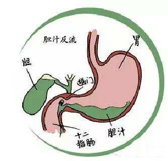 膽汁反流應該檢查什么項目_膽汁反流看的好嗎_膽汁反流為什么要看心理科