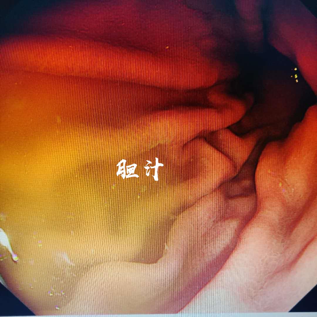 膽汁反流看的好嗎_膽汁反流應該檢查什么項目_膽汁反流為什么要看心理科